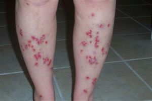 Leg sores caused by Morgellons